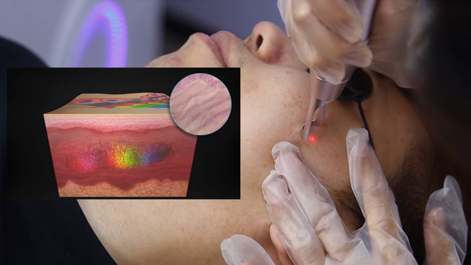 The Science Behind Tattoo Removal Machines: How Do They Work?